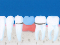 インプラント入れ歯は、天然の歯に比べると、どうしても噛む力が弱くなります。